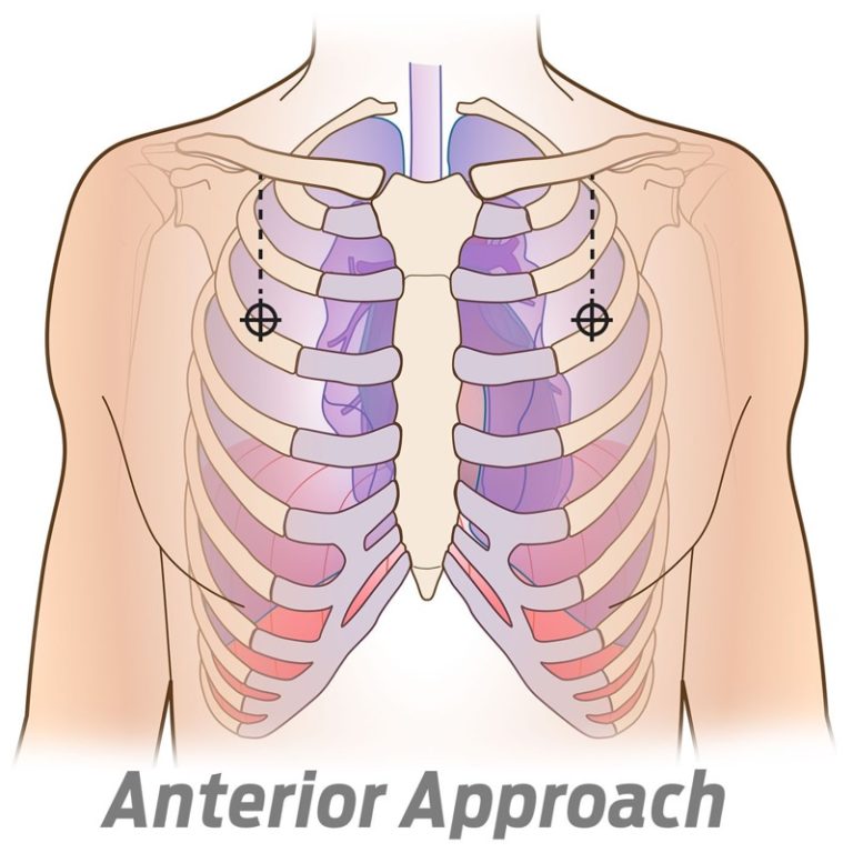 Needle, Decompression SPEAR - Simplified Pneumothorax Emergency Air ...